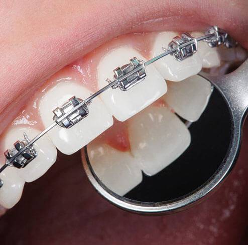 braces faqs